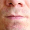 Skin irritation after shaving on man's skin. Closeup nose and lips